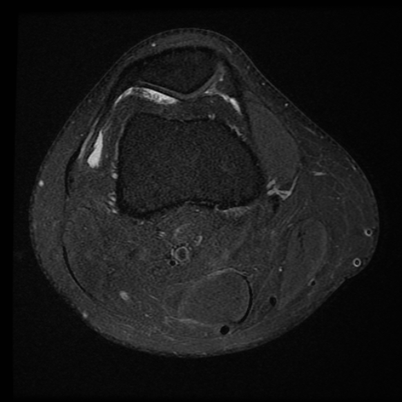 File:Anterior cruciate ligament tear with posteromedial corner injury, bucket-handle meniscal tear and chondral delamination (Radiopaedia 75501-86744 Axial PD fat sat 22).jpg