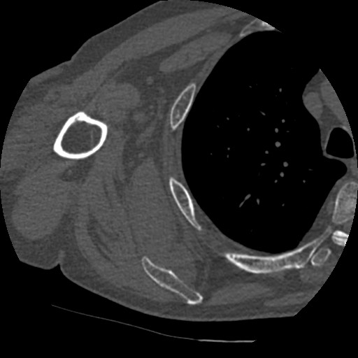 File:Anterior glenohumeral dislocation with Hill-Sachs lesion (Radiopaedia 62877-71249 Axial bone window 67).jpg
