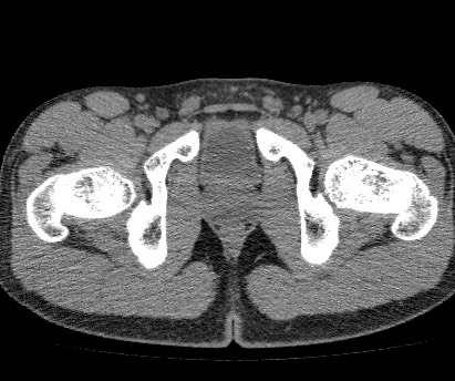 Anterior inferior iliac spine avulsion fracture (Radiopaedia 81312-94999 Axial non-contrast 61).jpg