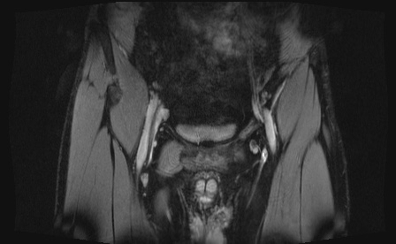 Anterior inferior iliac spine avulsion fracture (Radiopaedia 81312-95000 G 94).jpg