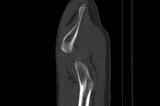 Anterior inferior iliac spine avulsion injury (Radiopaedia 88666-105376 Sagittal bone window 83).jpg