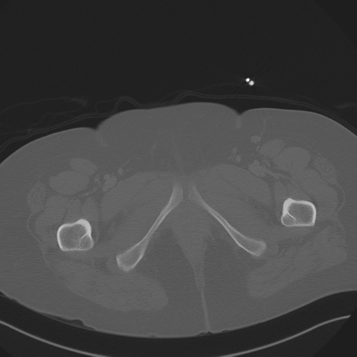 File:Anterior superior iliac spine avulsion fracture (Radiopaedia 44541-48244 Axial bone window 105).png