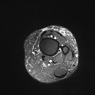 File:Anterior talofibular ligament injury - rupture with soft-tissue impingement (Radiopaedia 38765-40928 Axial T2 fat sat 2).jpg