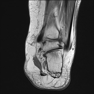 File:Anterior talofibular ligament injury - rupture with soft-tissue impingement (Radiopaedia 38765-40928 Coronal PD 12).jpg