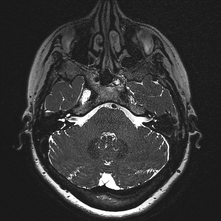 Anterior temporal encephalocele (Radiopaedia 82624-96808 Axial T2 high res 18).jpg
