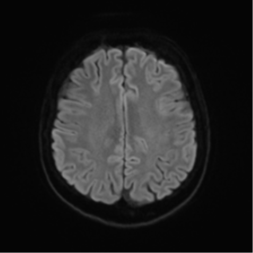 Anterior temporal lobe perivascular space (Radiopaedia 40946-43650 Axial DWI 46).png