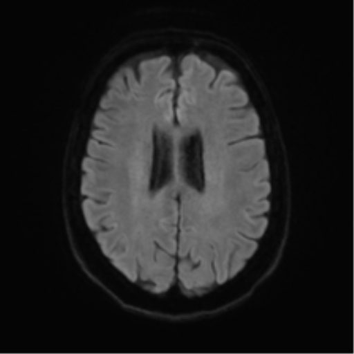 File:Anterior temporal pole cysts (Radiopaedia 46629-51102 Axial DWI 45).png