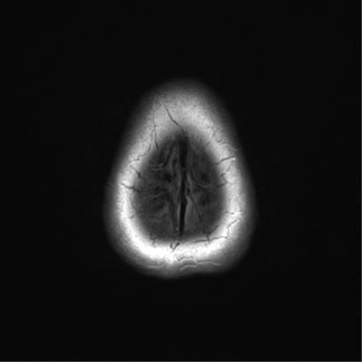 File:Anterior temporal pole cysts (Radiopaedia 46629-51102 Axial FLAIR 27).png
