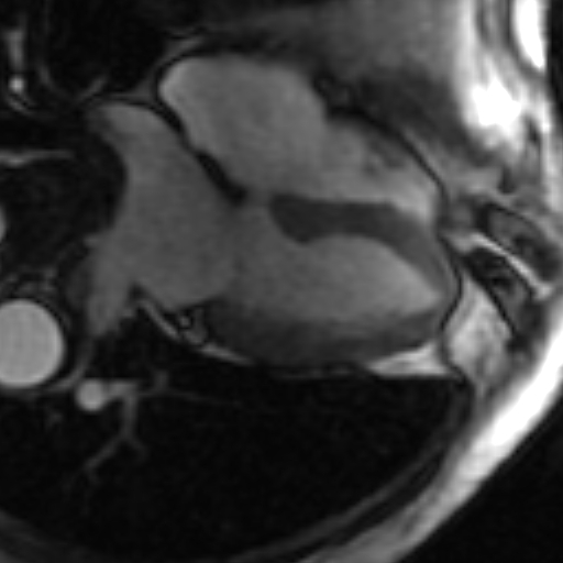 File:Anteroseptal hypokinesia after myocardial infarction (Radiopaedia 15978-15633 4 chamber view SSFE 9).jpg