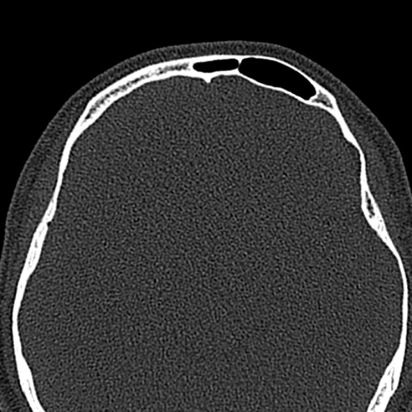 Antrochoanal polyp (Radiopaedia 30002-30554 Axial bone window 57).jpg