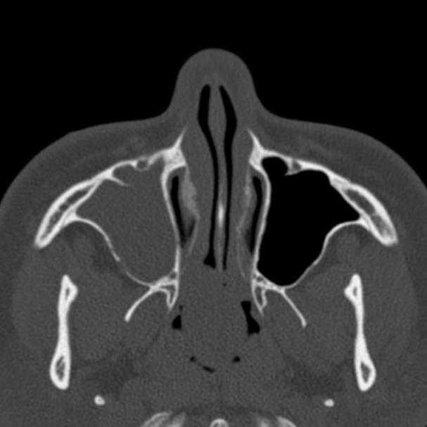 Antrochoanal polyp (Radiopaedia 33984-35202 Axial bone window 21).jpg