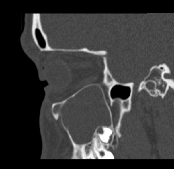 Antrochoanal polyp (Radiopaedia 33984-35202 Sagittal bone window 20).jpg