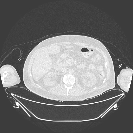 Aortic arch aneurysm (Radiopaedia 84109-99365 Axial lung window 330).jpg