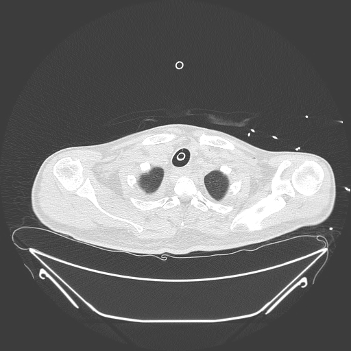 Aortic arch aneurysm (Radiopaedia 84109-99365 Axial lung window 45).jpg