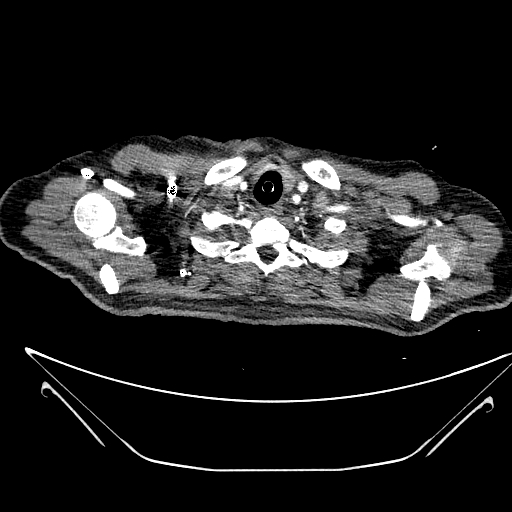 Aortic arch aneurysm (Radiopaedia 84109-99365 B 57).jpg