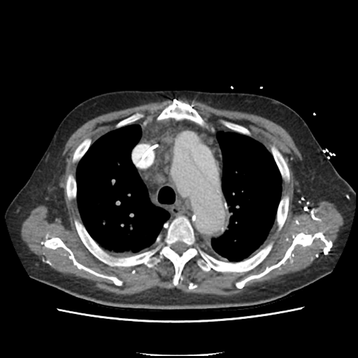 Aortic arch graft infection (FDG PET-CT) (Radiopaedia 71975-82437 A 14).jpg