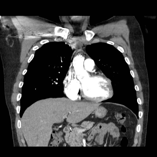 File:Aortic arch stent (Radiopaedia 30030-30595 F 5).jpg