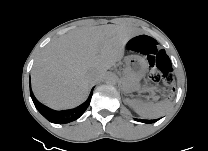 File:Aortic coarctation with aneurysm (Radiopaedia 74818-85828 A 34).jpg