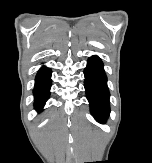 File:Aortic coarctation with aneurysm (Radiopaedia 74818-85828 C 107).jpg