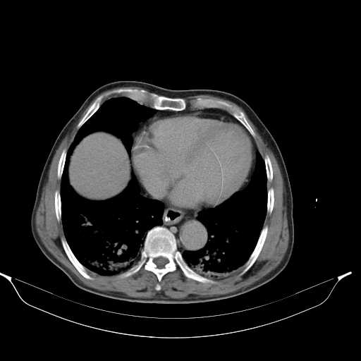 File:Aortic dissection- Stanford type A (Radiopaedia 22085-22085 Axial C+ delayed 2).jpg