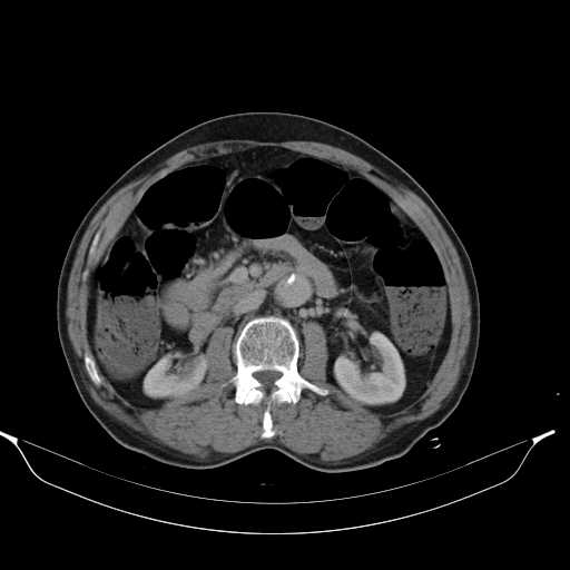 File:Aortic dissection- Stanford type A (Radiopaedia 22085-22085 Axial C+ delayed 23).jpg
