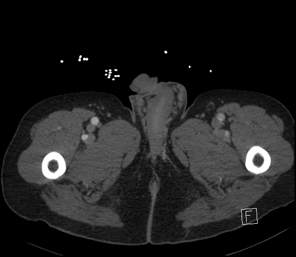 Aortic dissection (CTPA) (Radiopaedia 75506-86750 E 176).jpg