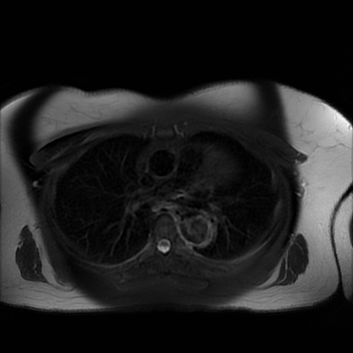 File:Aortic dissection (Radiopaedia 57969-64956 Axial T2 fat sat 1).jpg
