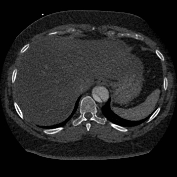 Aortic dissection (Radiopaedia 57969-64959 A 266).jpg