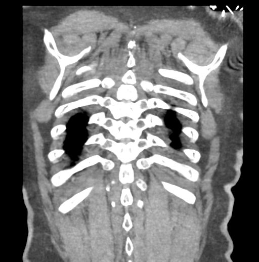 File:Aortic dissection - Stanford type B (Radiopaedia 50171-55512 B 76).png