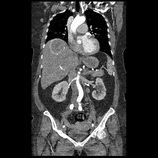 File:Aortic dissection - Stanford type B (Radiopaedia 88281-104910 B 31).jpg
