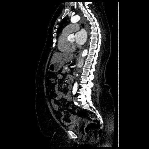 File:Aortic dissection - Stanford type B (Radiopaedia 88281-104910 C 43).jpg