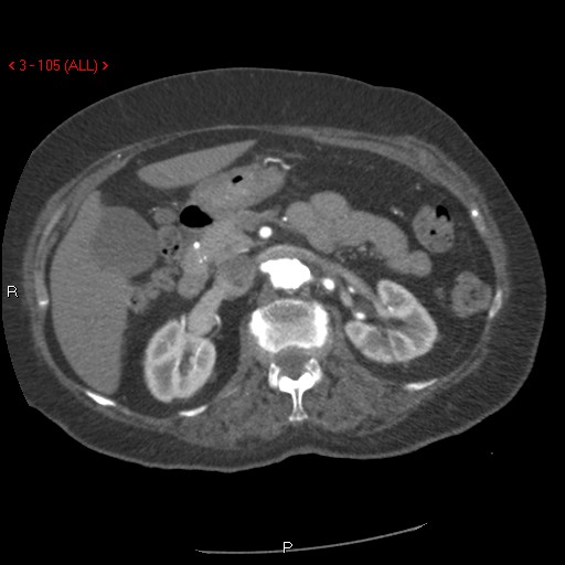 Aortic intramural hematoma (Radiopaedia 27746-28001 A 105).jpg