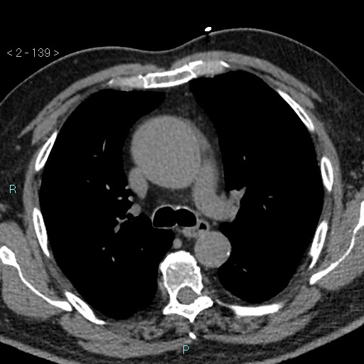 File:Aortic intramural hematoma (Radiopaedia 48463-53380 Axial non-contrast 61).jpg