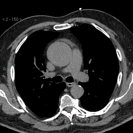 File:Aortic intramural hematoma (Radiopaedia 48463-53380 Axial non-contrast 66).jpg