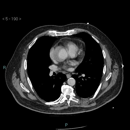 Aortic intramural hematoma (Radiopaedia 48463-53380 C 86).jpg