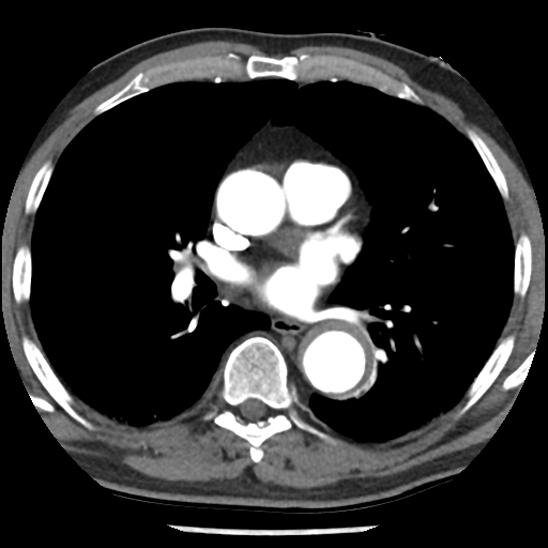 File:Aortic intramural hematoma (type B) (Radiopaedia 79323-92387 B 28).jpg