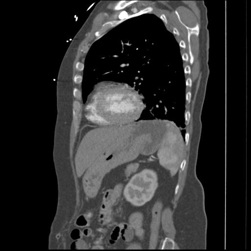 File:Aortic intramural hematoma from penetrating atherosclerotic ulcer (Radiopaedia 31137-31836 B 3).jpg