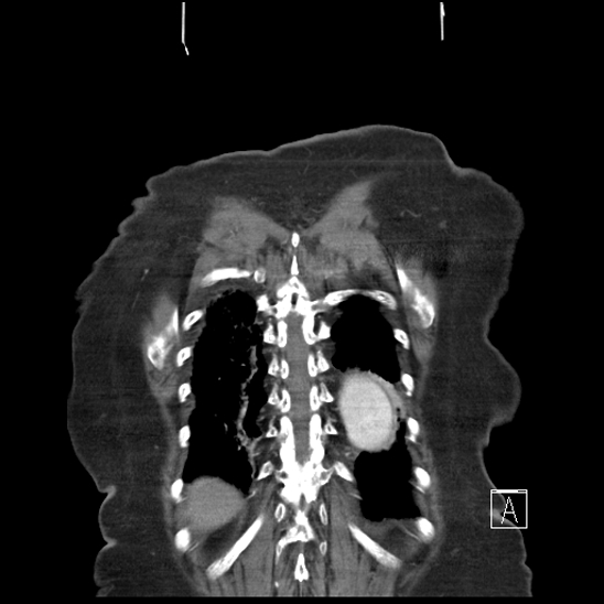 Aortic intramural hematoma with dissection and intramural blood pool (Radiopaedia 77373-89491 C 59).jpg