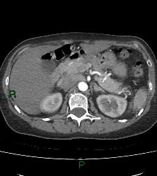 Aortic valve endocarditis (Radiopaedia 87209-103485 C 102).jpg