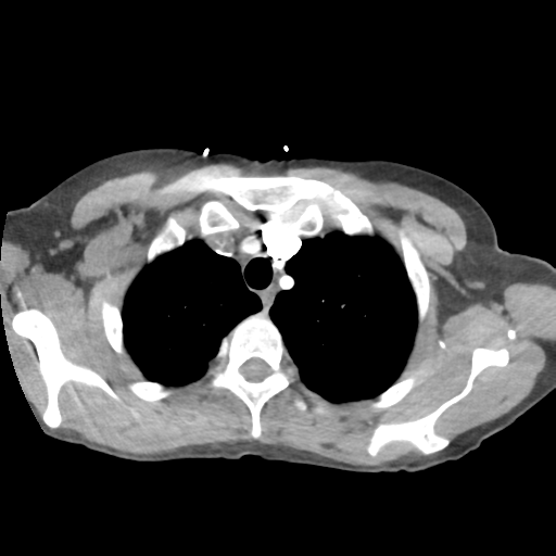 File:Aortic valve non-coronary cusp thrombus (Radiopaedia 55661-62189 B 9).png