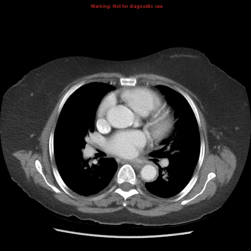 File:Aortic valve stenosis (Radiopaedia 14480-14423 C 1).jpg