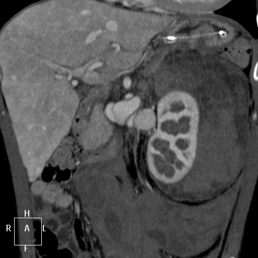 Aorto-left renal vein fistula (Radiopaedia 45534-49628 B 23).jpg