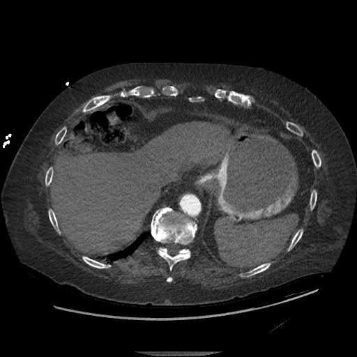 Aortoesophageal fistula with endovascular repair (Radiopaedia 73781-84592 Axial C+ CTPA 150).jpg