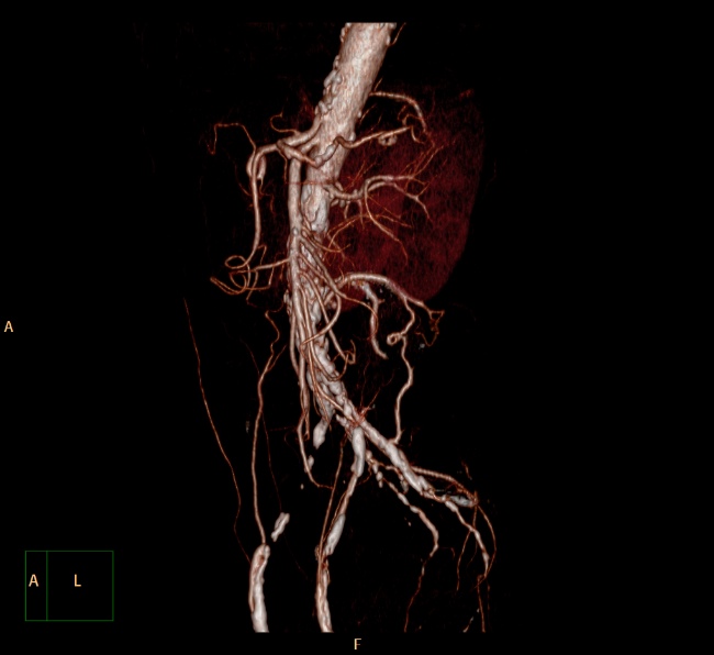 File:Aortoiliac occlusive disease (Radiopaedia 32134-33076 VR C+ arterial phase 13).jpg