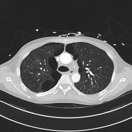 Apical bullous disease in a heavy smoker (Radiopaedia 33067-34092 Axial lung window 23).png