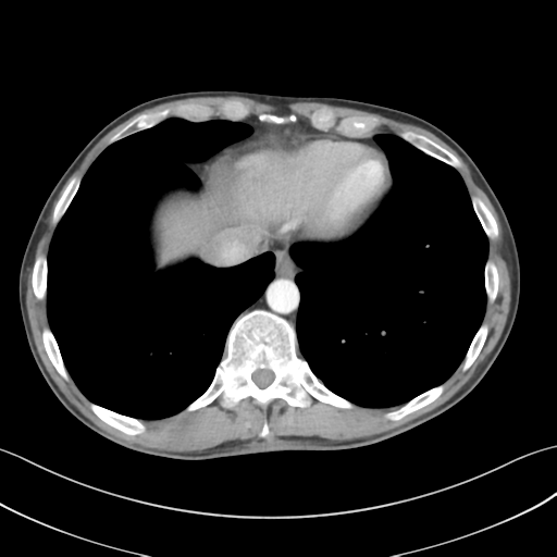 File:Apical pleural calcification (Radiopaedia 46141-50499 Axial C+ delayed 56).png
