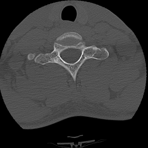 Apical pneumothorax on cervical spine CT (Radiopaedia 45343-49368 Axial bone window 74).jpg