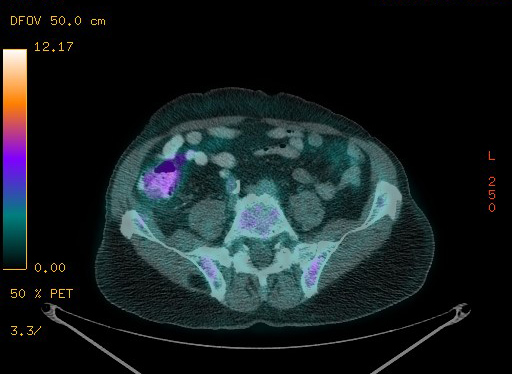Appendiceal adenocarcinoma complicated by retroperitoneal abscess (Radiopaedia 58007-65041 Axial PET-CT 154).jpg