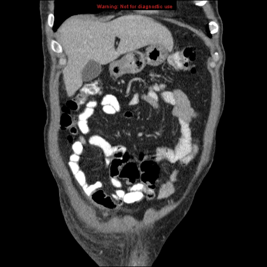 File:Appendicitis mass in inguinal hernia (Radiopaedia 26858-27029 B 13).jpg