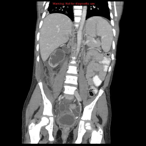 File:Appendicitis with phlegmon (Radiopaedia 9358-10046 B 43).jpg